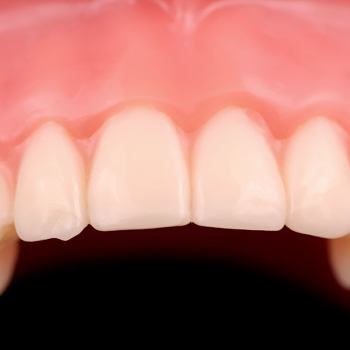 Upper Teeth 