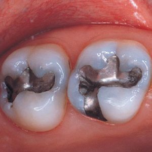 Mercury dental amalgam fillings are safe for most people