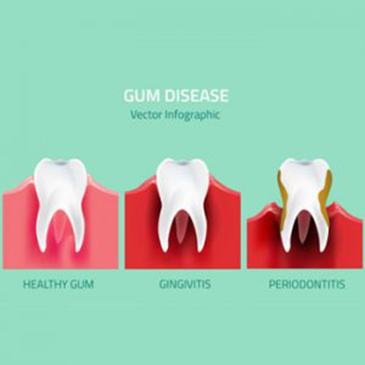 Gum disease vector 