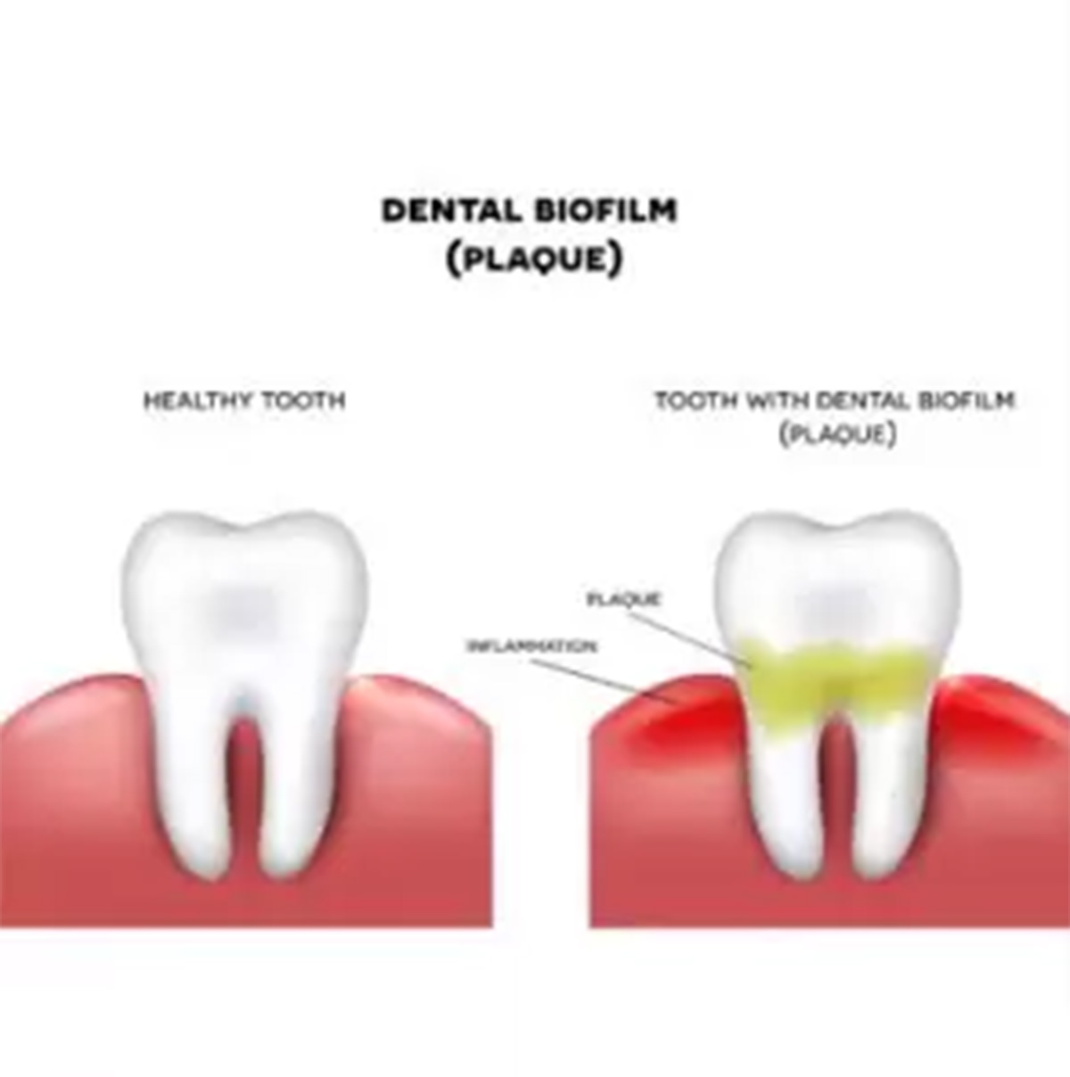 Dental Biofilm 