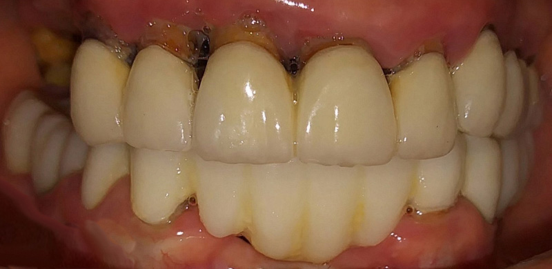 Before and After Dentures at Natural and Cosmetic Dentistry