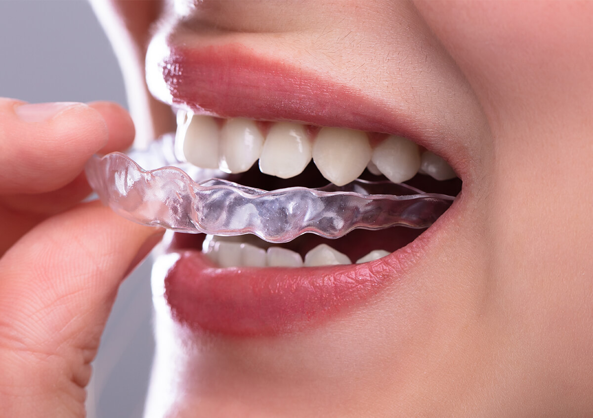 Straightening Teeth With Invisalign in Clearwater Area 