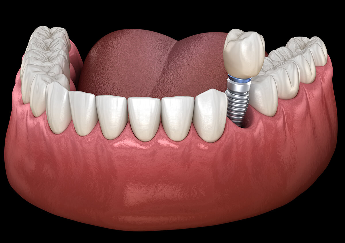 How to Care for Dental Implant Restorations in Clearwater FL Area 
